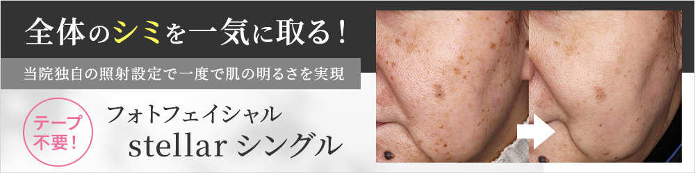 全体のシミを一気に取る！フォトフェイシャルstellarシングル