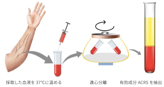 採取した血液から有効成分ACRSを抽出