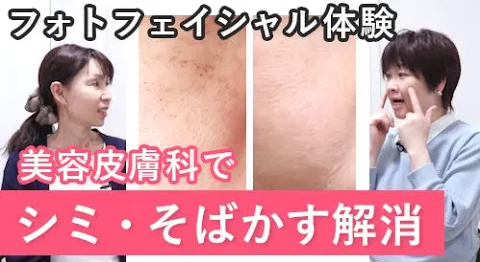 シミ・そばかす対策「フォトフェイシャル体験」