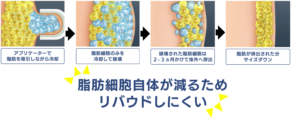 脂肪細胞自体が減るためリバウンドしにくいクールスカルプティング（クルスカ）