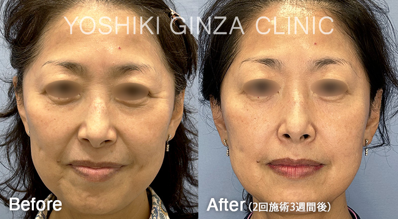 ほうれい線の症例写真 2回施術3週間後