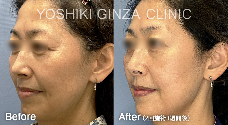 ほうれい線の症例写真 2回施術3週間後