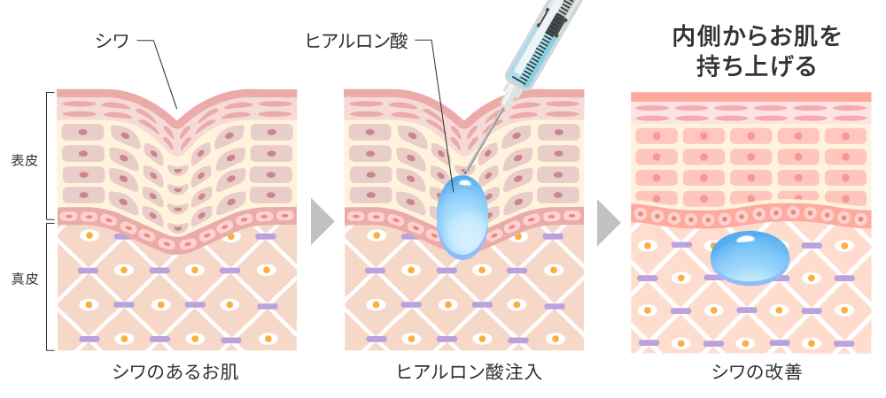 ヒアルロン酸注射イメージイラスト