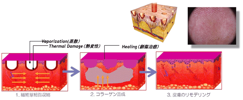 モナリザタッチの効果