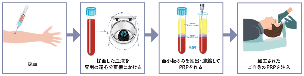 PRPの採血から注入までの流れ