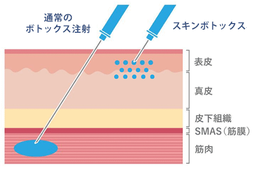 スキンボトックスと通常のボトックス注射の違い