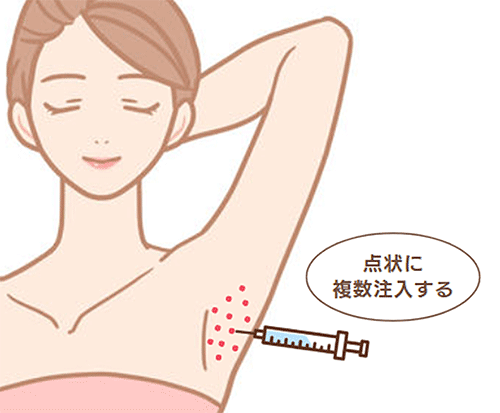 脇ボトックスは点状に複数注入します