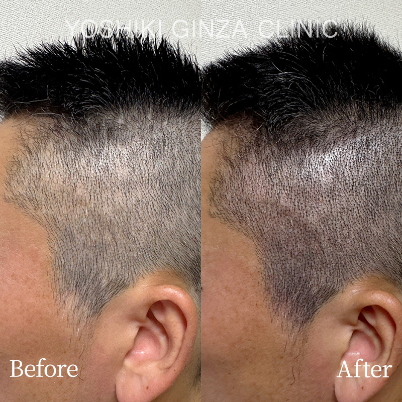 ヘアアートメイクの症例写真