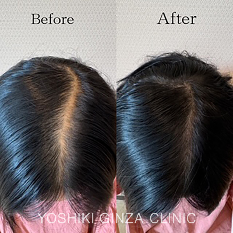 ヘアアートメイクの症例写真