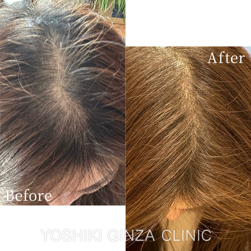 ヘアアートメイクの症例写真