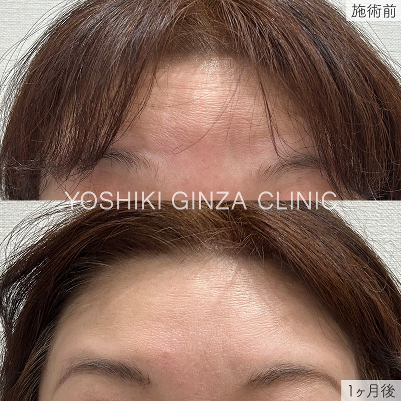 ボツリヌス注射（額）の症例写真