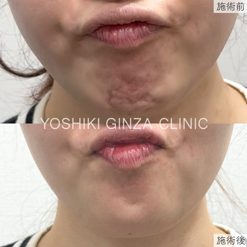 ボツリヌス注射（あご（梅干しジワ））の症例写真