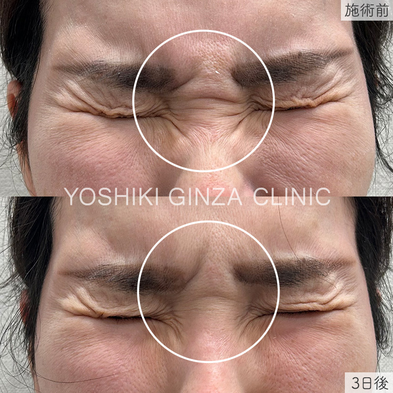 ボツリヌス注射（眉間＋鼻根(バニーライン)）の症例写真