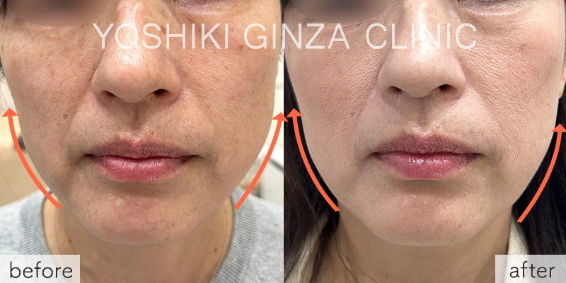 ボツリヌス注射（えら）の症例写真