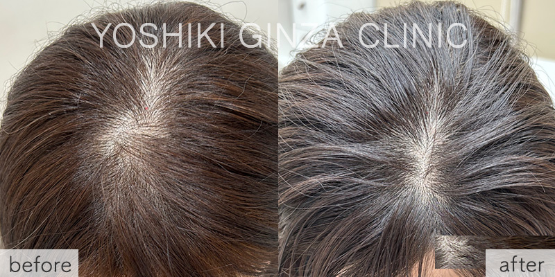 ボツリヌス注射（頭皮）の症例写真