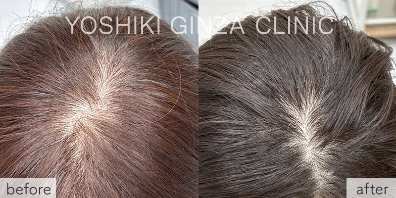 ボツリヌス注射（頭皮）の症例写真