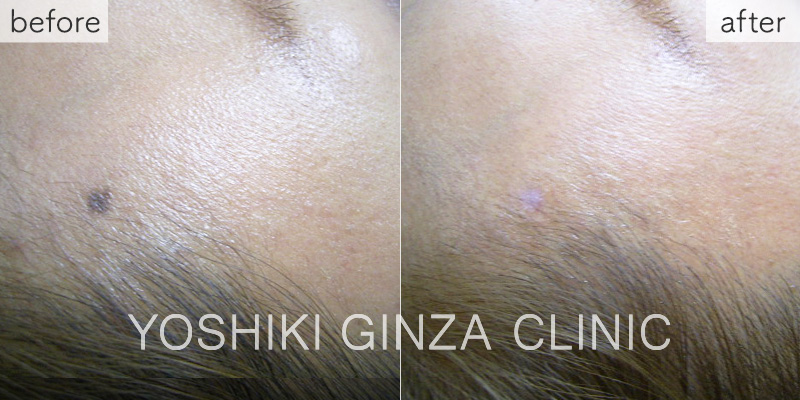 炭酸ガスレーザー ほくろの症例写真