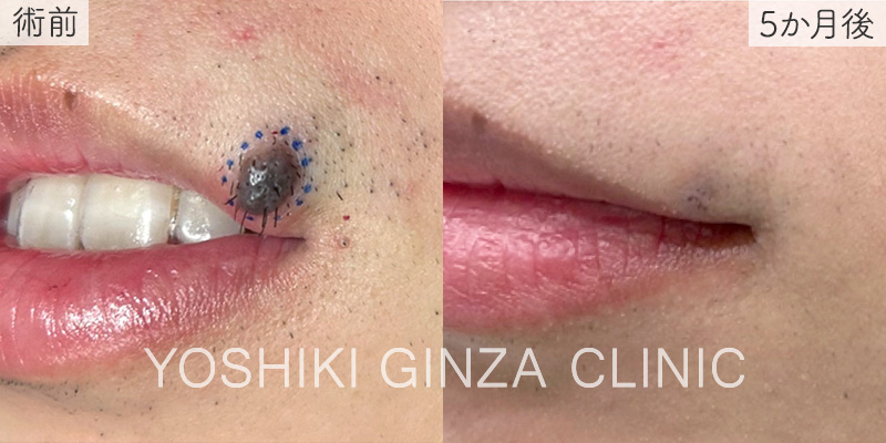 炭酸ガスレーザーの症例写真