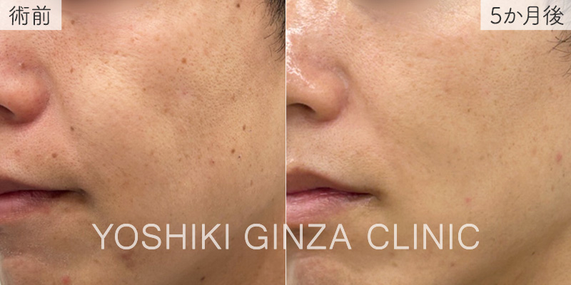 CO2レーザーの ほくろ症例写真