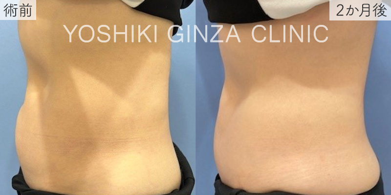 クルスカ 下腹部/両腹側部の横側の症例写真