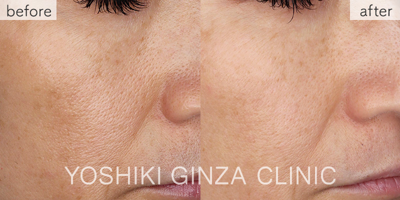 キュラセン(水光注射でプラセンタ注入)症例写真