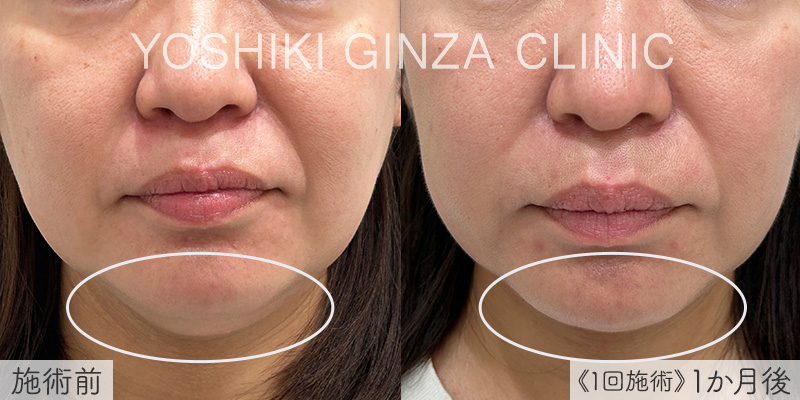 デンシティ（ほほ）の症例写真