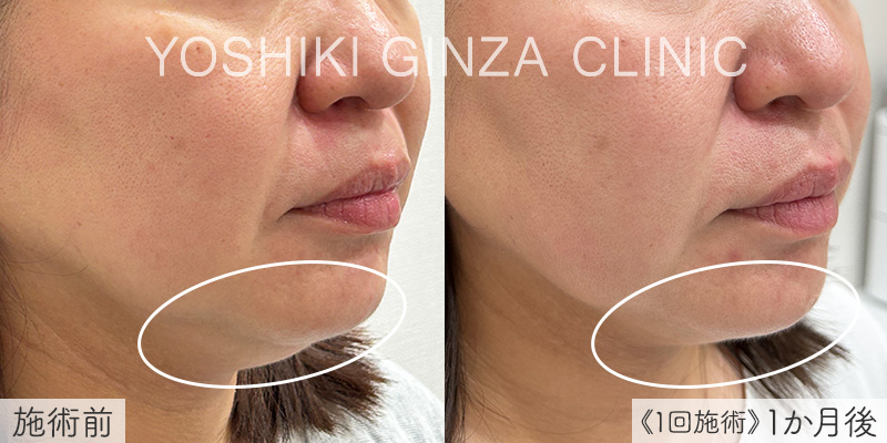 デンシティ（ほほ）の症例写真