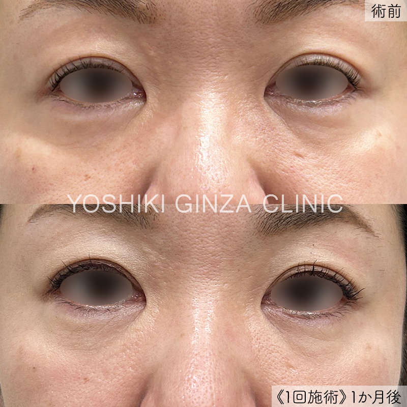 デンシティ（目元上下）の症例写真