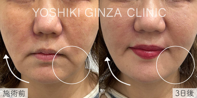 デンシティ（ほほ＋顎下）の症例写真