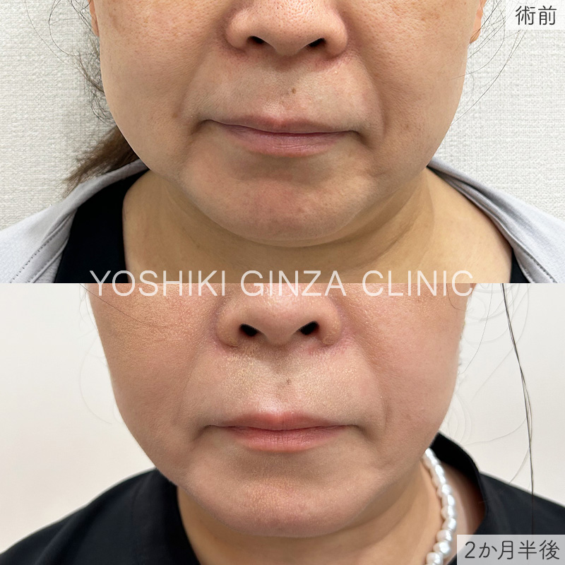 脂肪溶解注射の症例写真