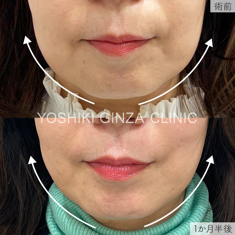 脂肪溶解注射の症例写真