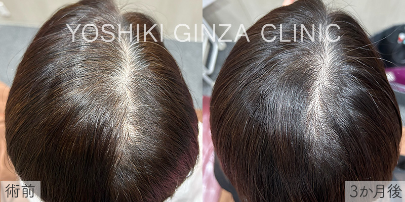 頭皮水光注射（ミノキシジル注入）×6回の症例写真