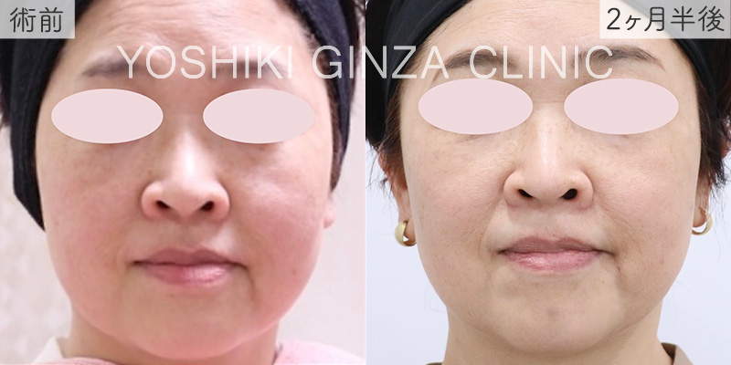 ハイフ（UTIMS）ほほの症例写真