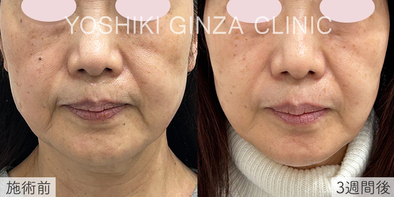 ハイフ（UTIMS）ほほ上下セットの症例写真