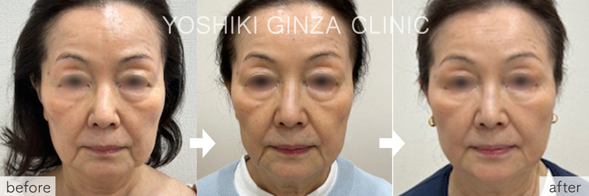 ヒアルロン酸注入の症例写真