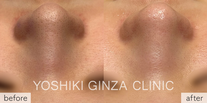 ハイドラフェイシャルの症例写真