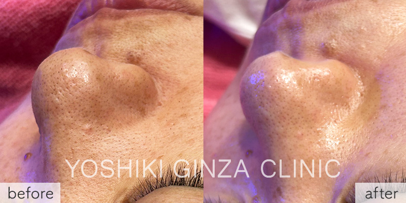 ハイドラフェイシャルの症例写真