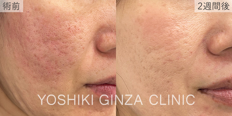 ジュベルック 両頬の症例写真