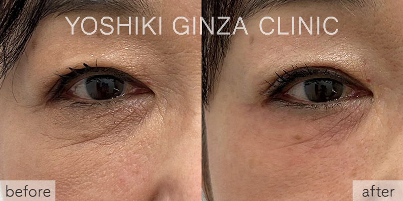 ジュベルック 目元の症例写真