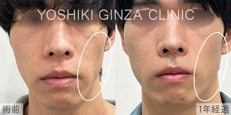 ジュベルック 左ほほの症例写真