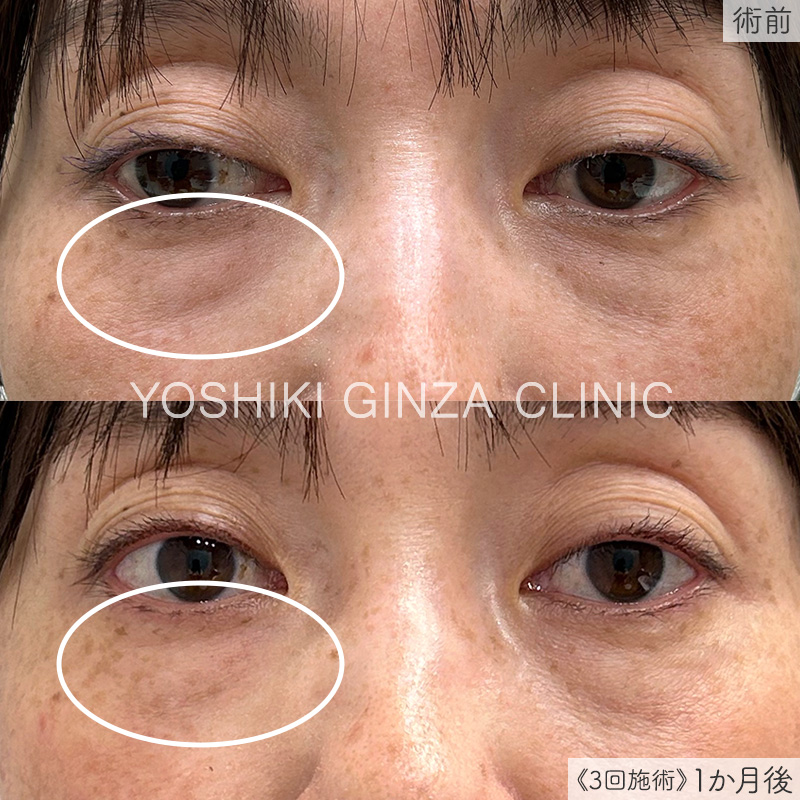 ジュベルック 目元のシワ症例写真