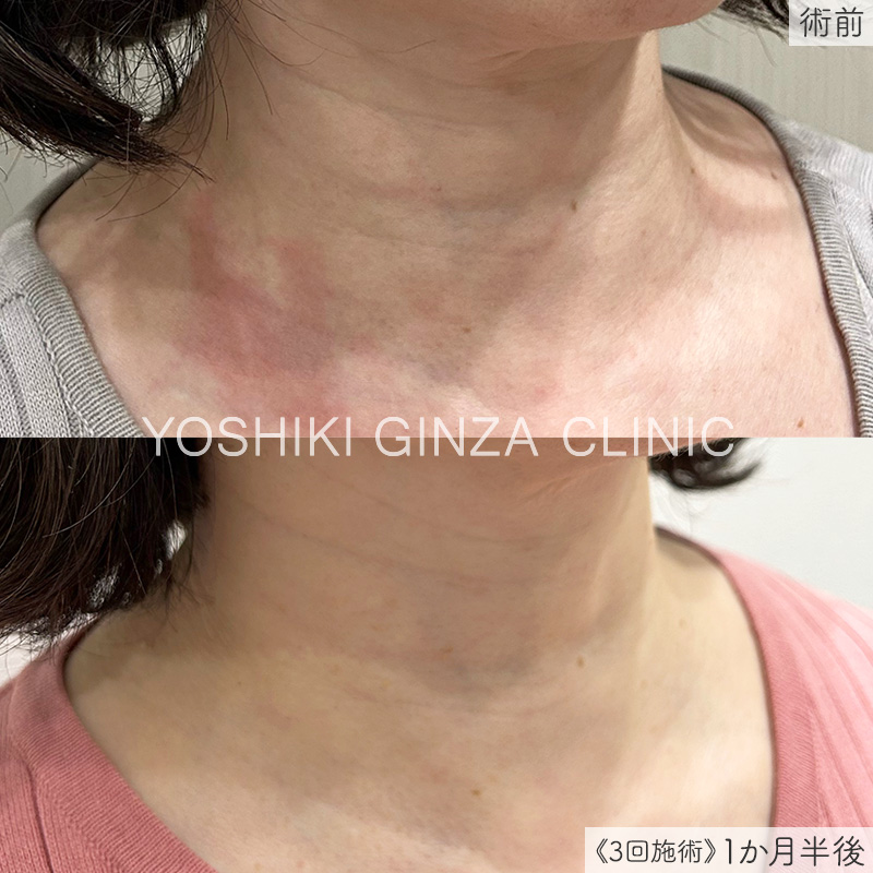 ジュベルック 首のシワ症例写真