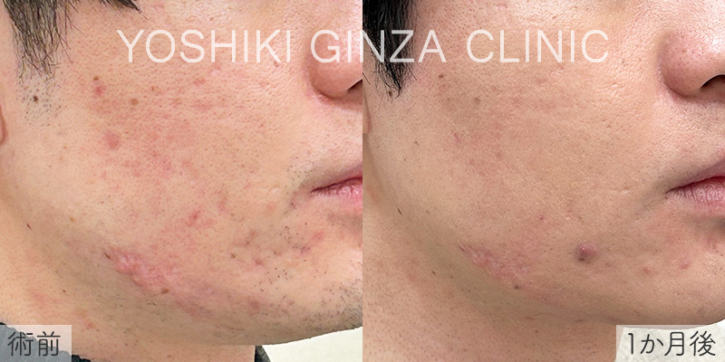 ジュベルック 両ほほニキビ跡の症例写真