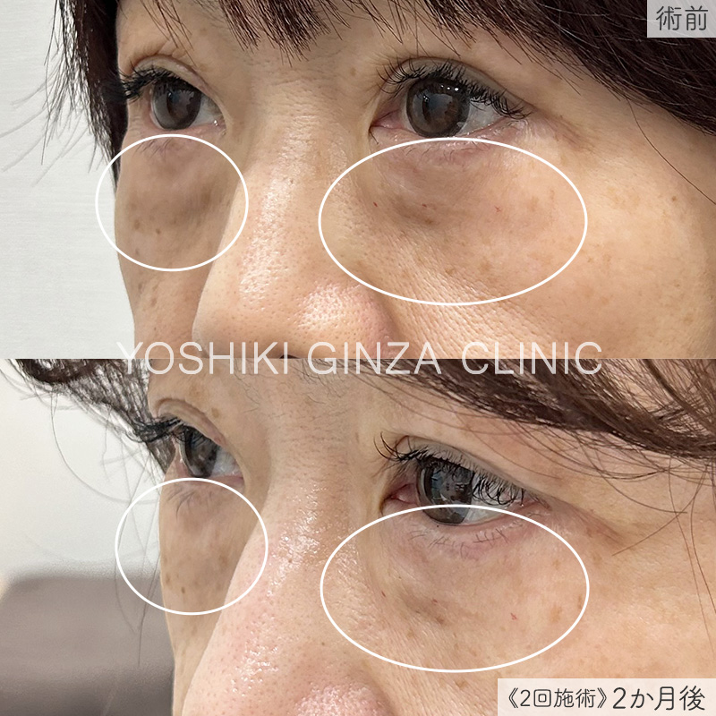 ジュベルック 目元のシワ症例写真