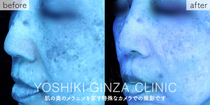 メソナJ《美白：メソナイエロー》の症例写真