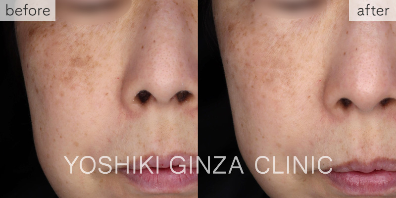 メソナJ《美白：メソナイエロー》の症例写真