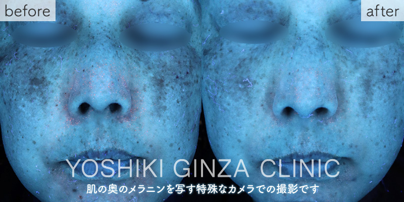 メソナJ《美白：メソナイエロー》の症例写真