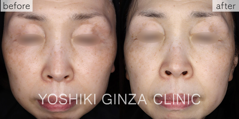 メソナJ《スペシャルコース》の症例写真