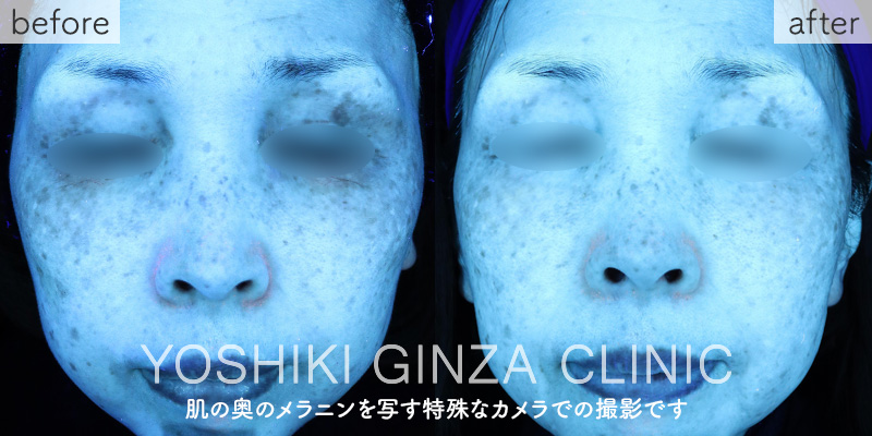 メソナJ《スペシャルコース》の症例写真