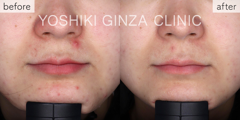 メソナJ《スペシャルコース》の症例写真